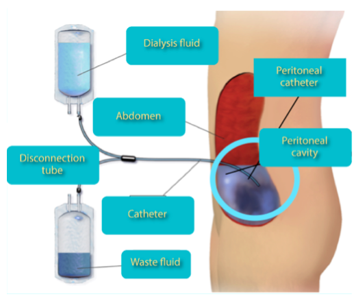 Different Types Of Dialysis Catheters